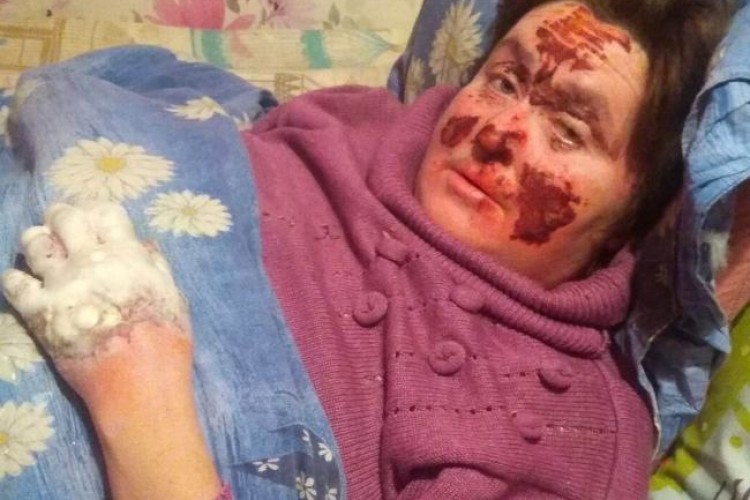 Волинянин підпалив свою співмешканку, а сам... помер від алкогольного отруєння