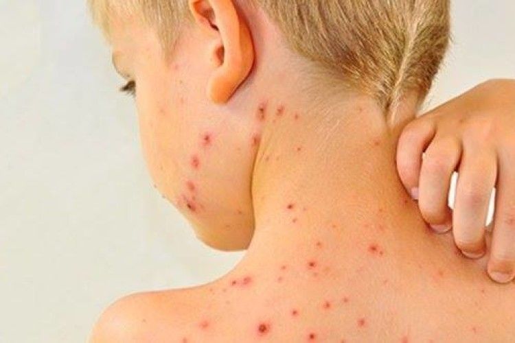 У Луцьку найвищий рівень захворюваності на кір та найнижчий рівень вакцинації в області