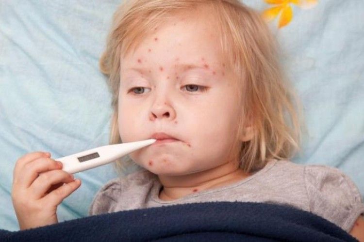 Волинян атакує кір, хоча маємо бельгійську вакцину