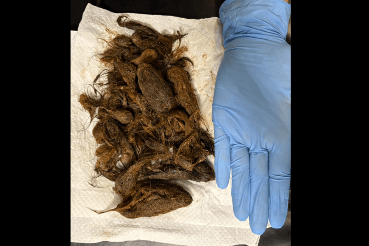 Волинські хірурги витягли 700-грамовий клубок волосся з шлунка 7-річної дівчинки