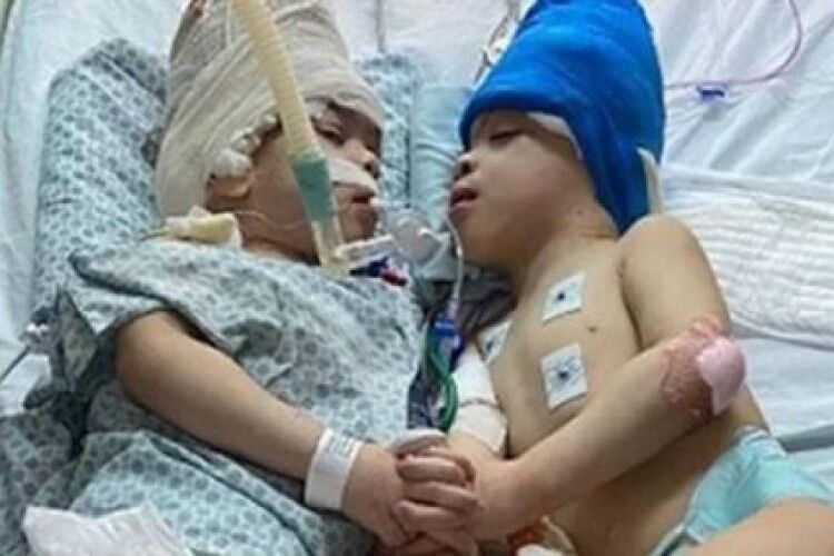 Сто медиків оперували 27 годин: лікарям вдалося розділити голови сіамських близнюків