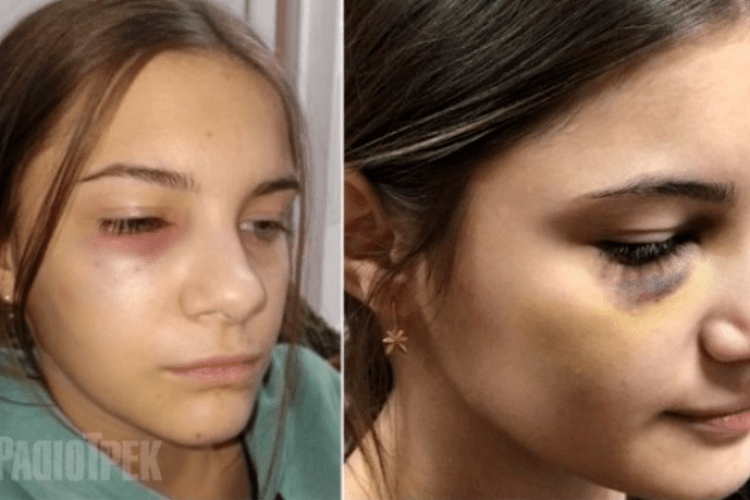 13-річний школяр у Рівному жорстоко побив дівчину (Фото)