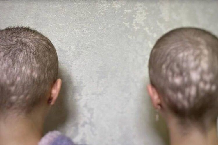 Хотіли схуднути: на Львівщині школярки-двійнятка втратили волосся через передозування вітамінами