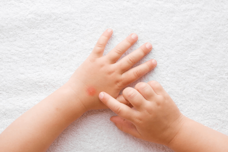 На Волині від укусів кліщів постраждала 21 дитина