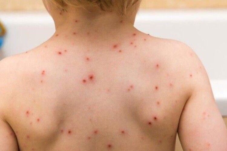 На заході України – спалах вітряної віспи 