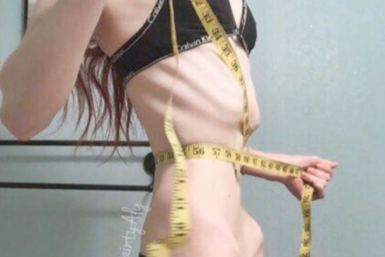 У 19 років важила 29 кг: на Прикарпатті  від анорексії померла дівчина