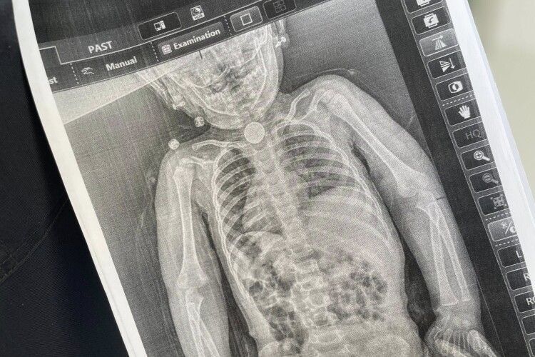 У Львові прооперували 2-річну дівчинку, яка три місяці прожила з батарейкою у стравоході