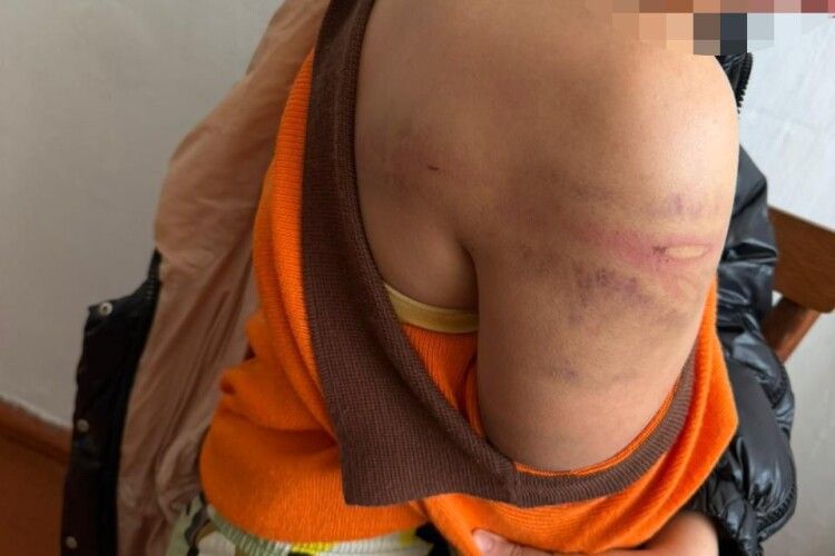 У Рівному батько побив доньку гумовим шлангом