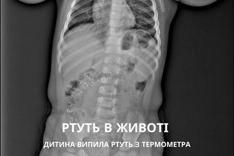 На Рівненщині дитина проковтнула ртуть з термометра