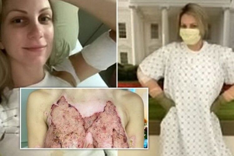 «Думала, що помру»: груди молодої дівчини «розтанули» після того, як вона впала на гарячу каструлю (ФОТО)