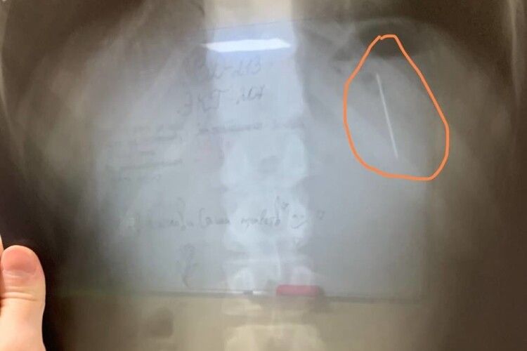 13-річний хлопець випадково проковтнув голку (Фото)