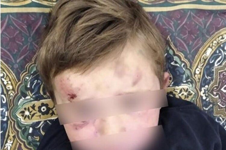 На Тернопільщині чоловік відгамселив чотирирічного пасинка: у дитини струс мозку та перелом ноги