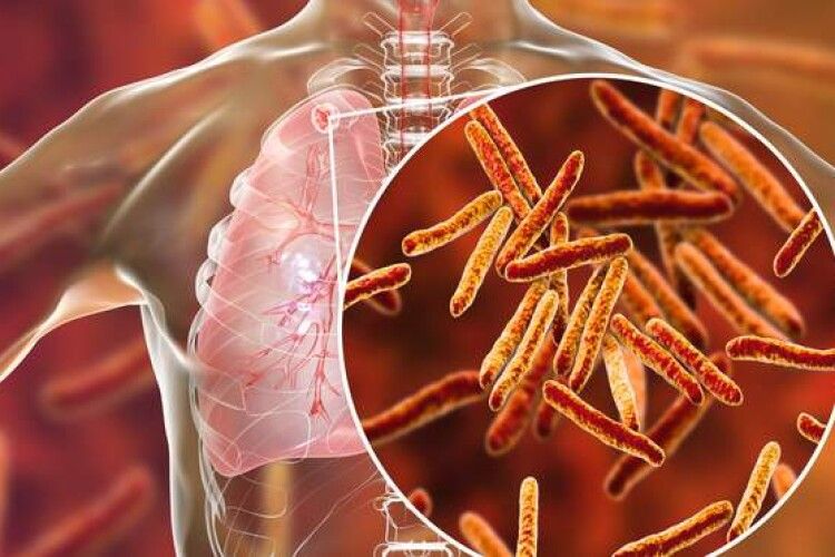 Учені винайшли ще один ефективний метод лікування туберкульозу
