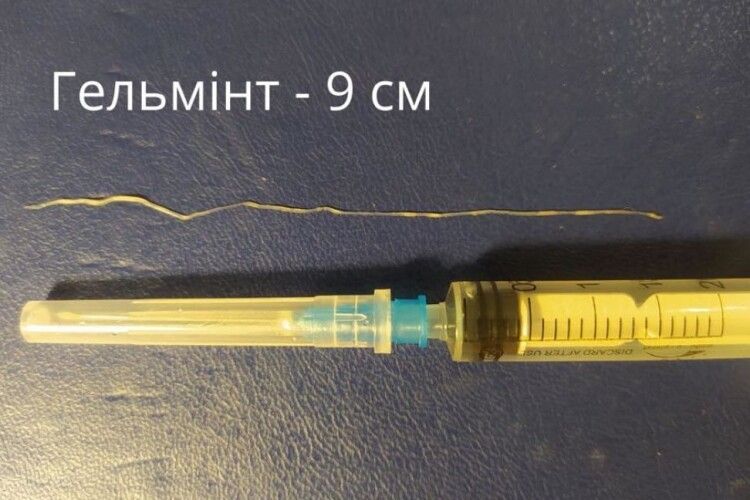 У волинянки з ока витягнули 9-сантиметрового глиста