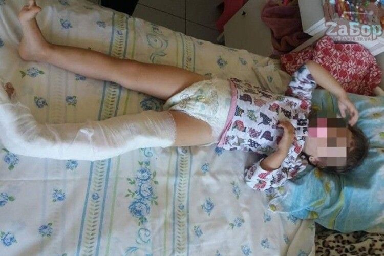 Вихователі не надали допомогу: дівчинка сильно травмувалася в дитсадку (Фото)