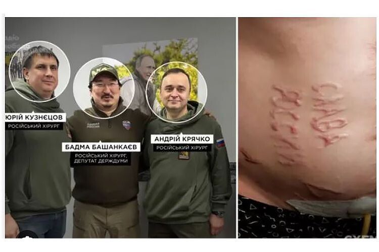 Встановили російських хірургів, які випалили «Слава россии» на тілі українського полоненого