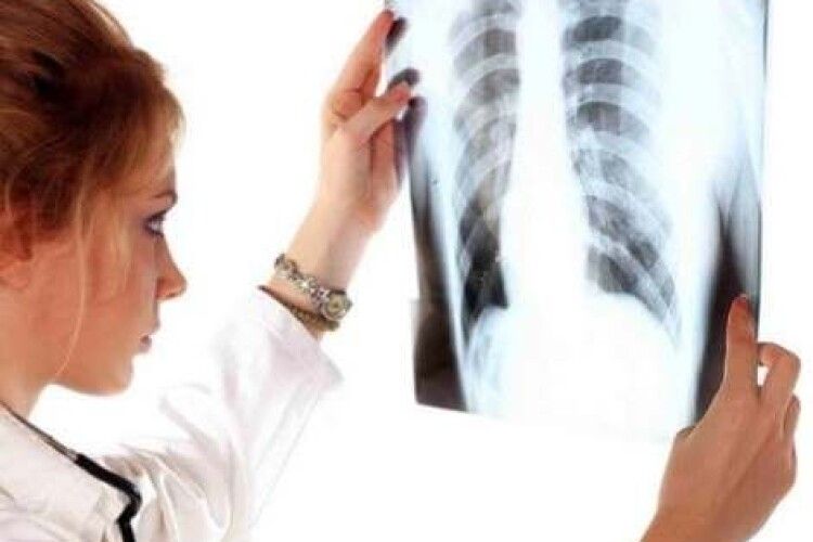 На Волині – ріст захворюваності на туберкульоз серед дітей