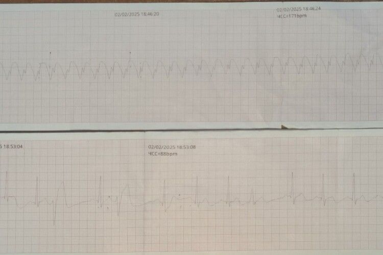 Медики успішно відновили серцевий ритм 65-річному волинянину за допомогою кардіоверсії