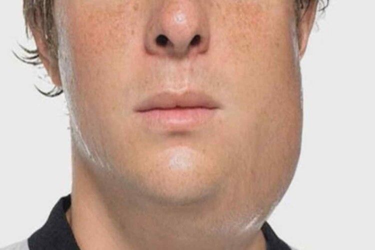 Ще одна «дитяча» інфекція нагадала про себе: на Волині – спалах вірусного паротиту