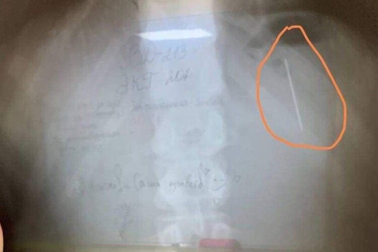 Тринадцятирічний хлопчик проковтнув голку