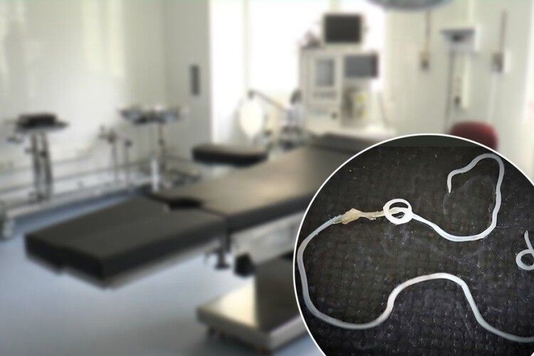 На Рівненщині лікарі видалили пацієнтці з-під шкіри гельмінта завдовжки 9 сантиметрів