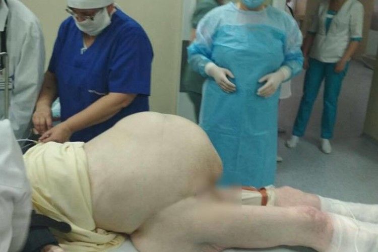 У Рівному лікарі видалили пацієнтці... 27-кілограмову пухлину 