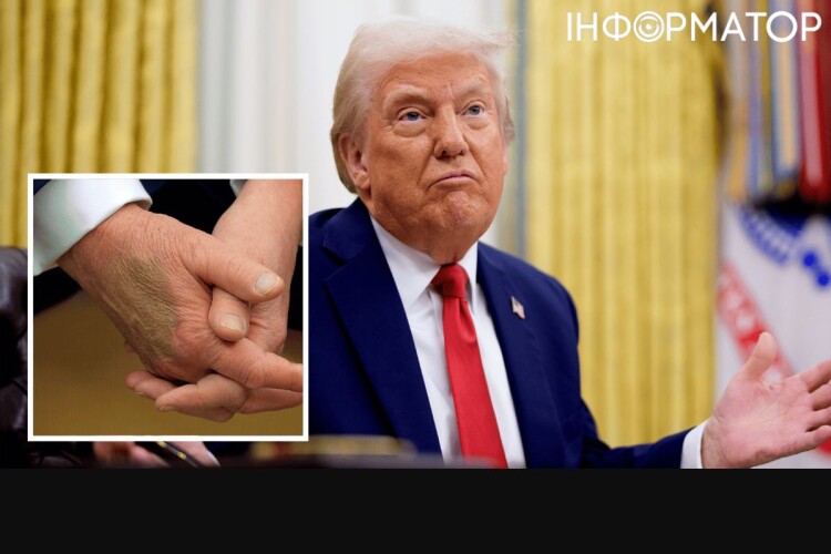 Звідки у Дональда Трампа з’явилися синці?
