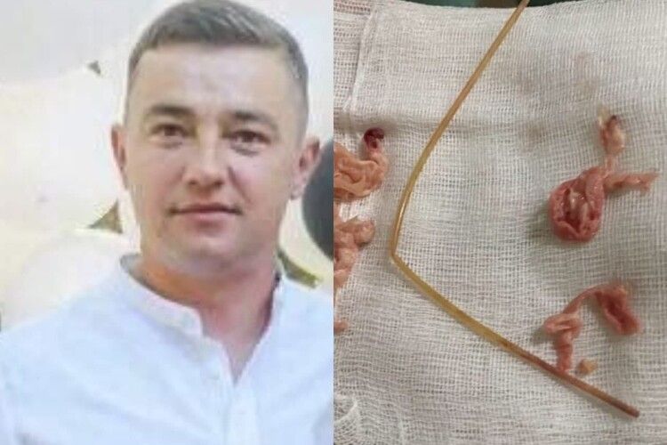 Злили всю кров, а температуру знизили до 18 градусів: лучанину зробили унікальну операцію на серці