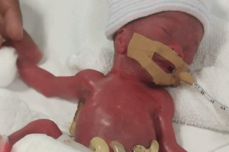 Лікарі виходили крихітку, яка народилася з вагою 212 грамів (Фото)