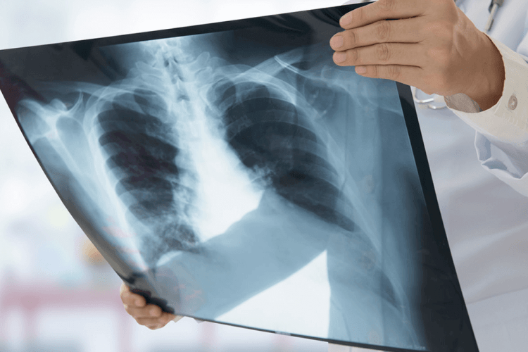 На Волині майже вдвічі зросла захворюваність на туберкульоз серед дітей