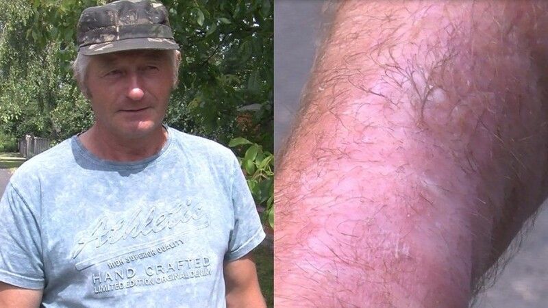Василь Куцик на собі переконався, що небезпечною є навіть крапля роси з борщівника.
