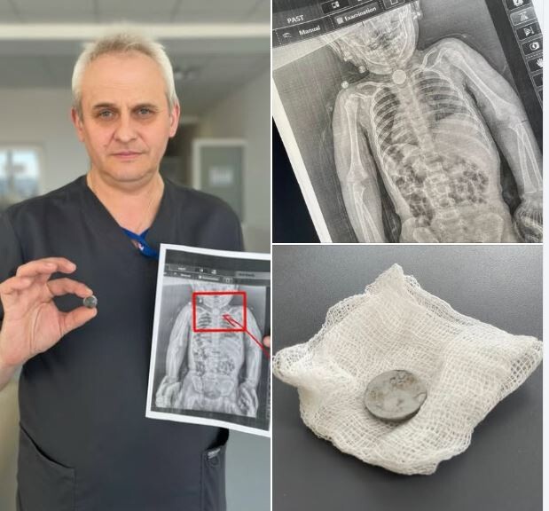 «До біди – одна мить»: дитячий хірург Володимир Федусь закликає батьків маленьких дітей пильно стежити  за своїми чадами, які граються іграшками, що мають дрібні деталі чи батарейки. Фото: «Перше медичне об’єднання Львова».