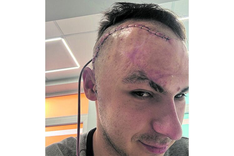 Лікар львівської приватної клініки «Родина» поставив Максимові безкоштовно титанову пластину, яка після важкого поранення була йому життєво необхідна.  