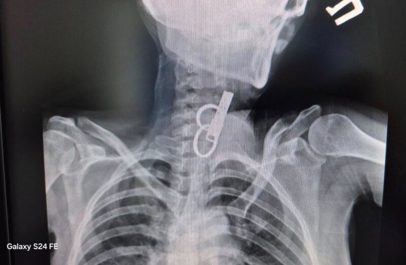 Ось через ці ключі, які опинилися в стравоході, жінка була за крок від смерті.