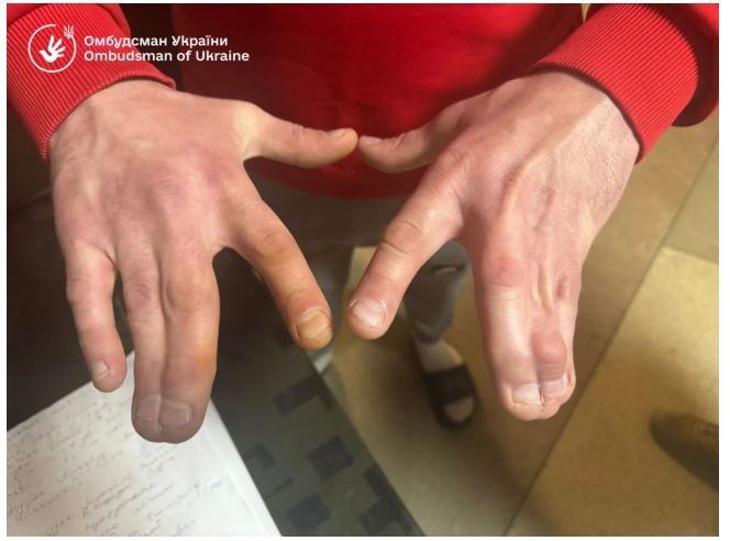 Руки-калічки. Фото: Омбудсман України.
