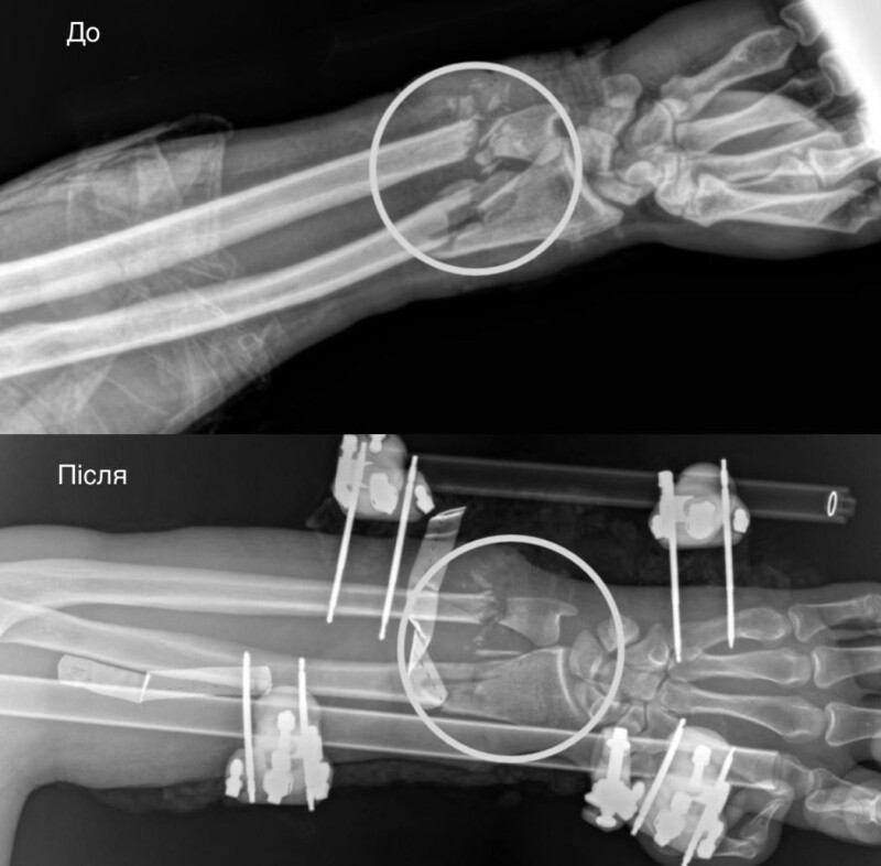 Рука «до» і «після» операції.
