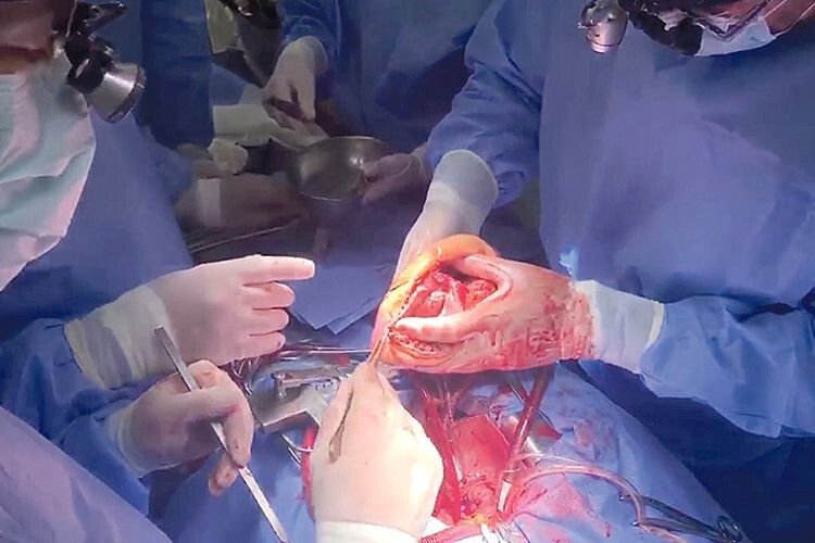 Трансплантацію львівські лікарі провели спільно з командою кардіохірургів столичного Інституту серця на чолі з Борисом Тодуровим.